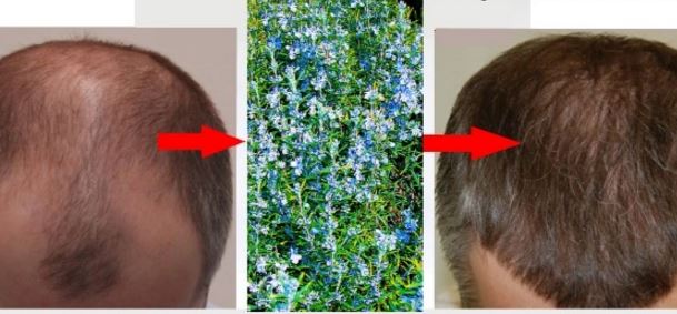 Rosemary oil benefits - preventing hair loss or baldness