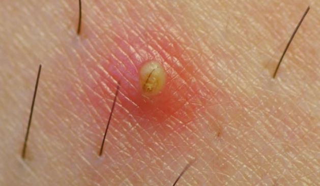 Deep ingrown hair