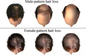 testosterone hair loss in men and women