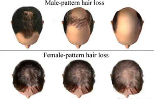 testosterone hair loss in men and women