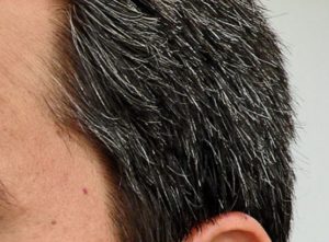 How to get rid of white hair permanently