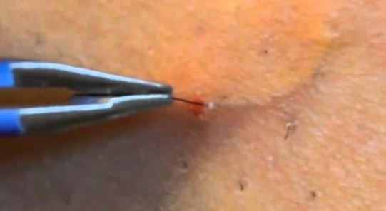 how-to-remove-deep-ingrown-hair