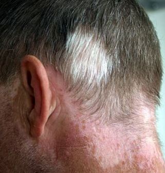 Poliosis and some autoimmune diseases can cause white hair