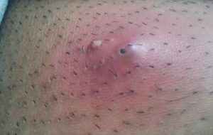 Swollen ingrown hair bumps