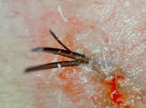 Follicle one multiple hairs growing from Tiny White