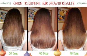 Before-and-after-pictures-onion-juice-on-hair-Source ...
