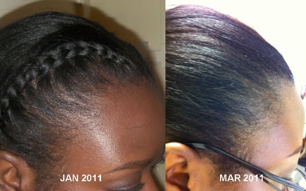 Black hair growth with miconazole