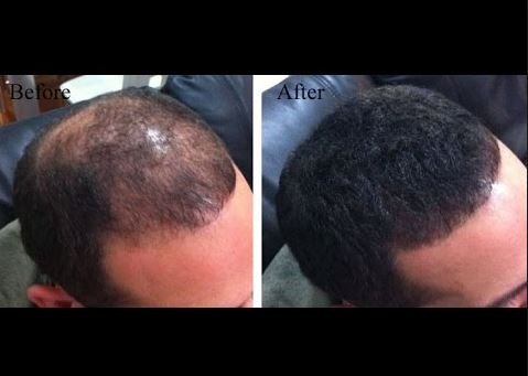 Hair regrowth with onion juice before and after pictures