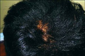 Hair breakage-crown-root-hair of the head