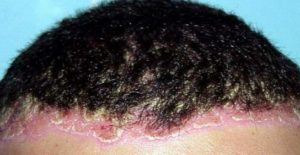 Scalp fungus can make your hair smell bad