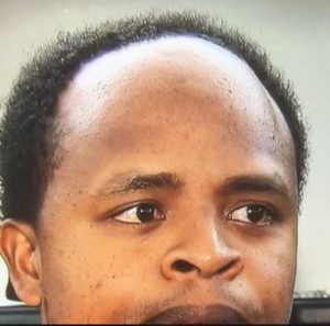 Receding hairlines in black men