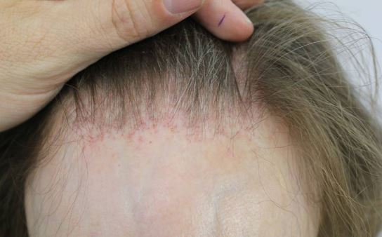 Receding front hairline in women due to hair loss