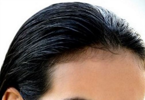 Receding hairline in women