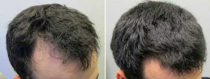 Beta Sitosterol Hair Loss, Dosage, with Saw Palmetto & Results | Hair Mag