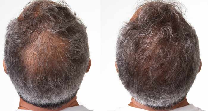 nioxin before after results men